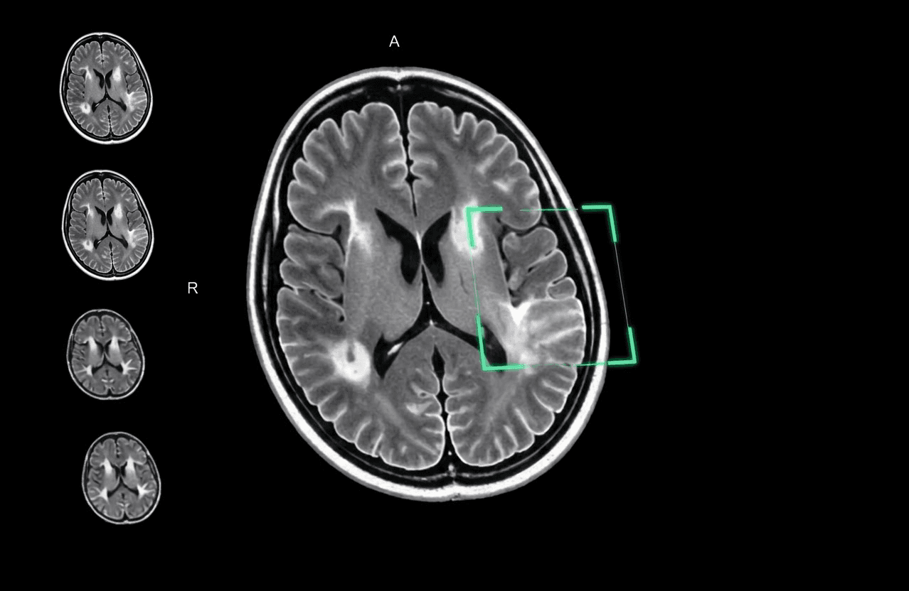 MRI brain scan viewer with prior-study thumbnails and an AI-flagged region of interest outlined in green