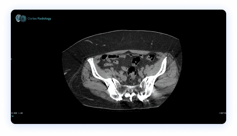 Cortex CT viewer showing an axial pelvic CT slice